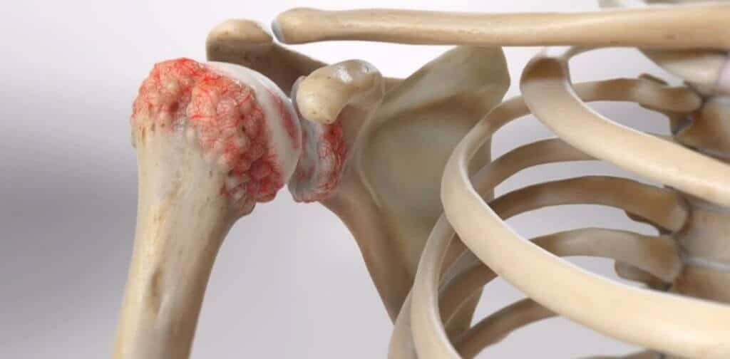 Shoulder Pain Treatment in Nashik